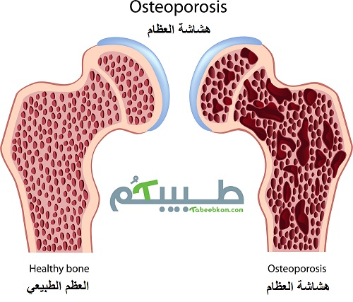 هشاشة العظام (Osteoperosis) هو مرض يصيب العظام بحيث لا يقدر الجسم على بناء العظم الجديد بنفس السرعة التي يُمتص بها العظم القديم
