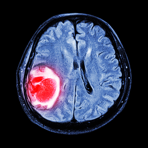 ورم دماغي كما يظهر في فحص الـ MRI