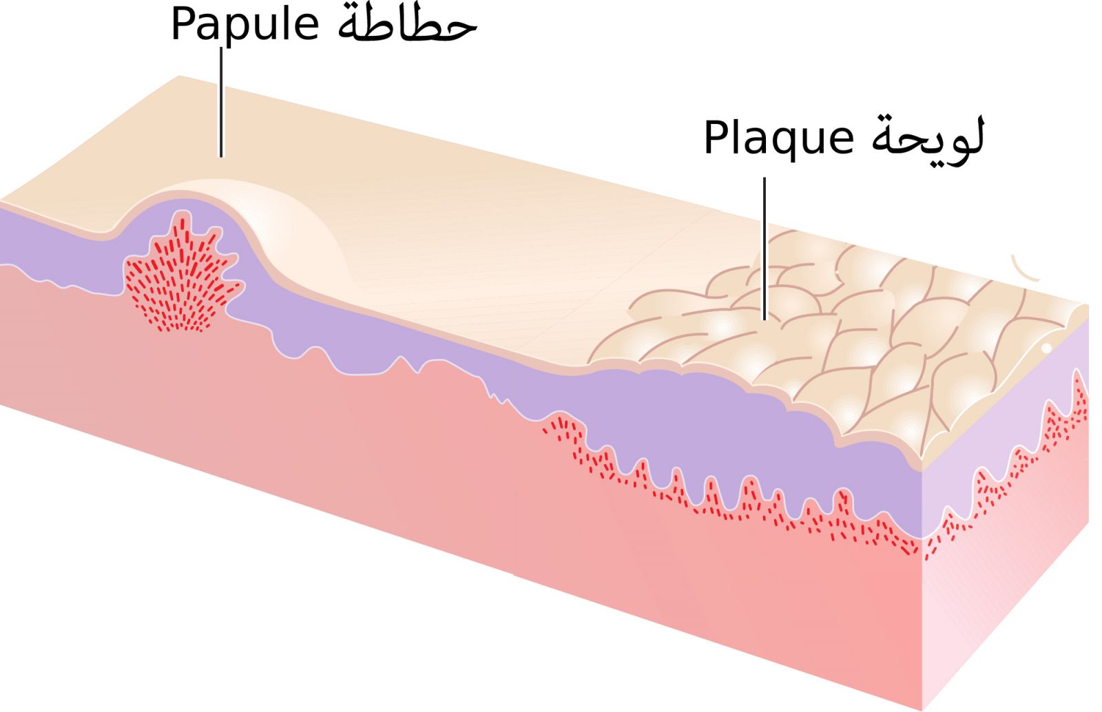 حطاطة (Papules) وهي نوع من حبوب الشباب الحمراء صغيرة الحجم تنمو تحت الجلد