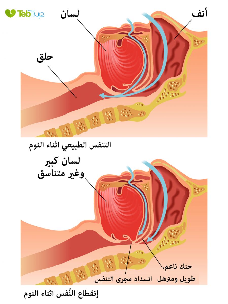 انقطاع التنفس الانسدادي أثناء النوم