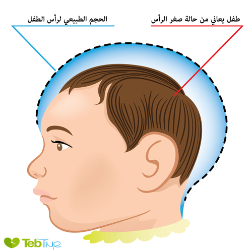 صورة توضح حالة صغر الرأس microcephaly