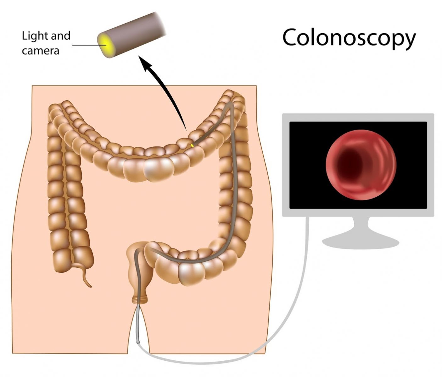 تنظير القولون – Colonoscopy: يتم اللجوء اليه لفحص القولون العصبي في بعض الاخيان