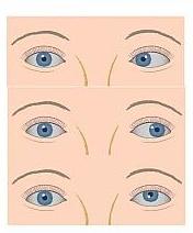 الحول (Strabismus)