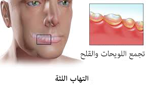 التهاب اللثة: تجمع اللويحات (dental plaque) من الاسباب الاكثر شيوعاً