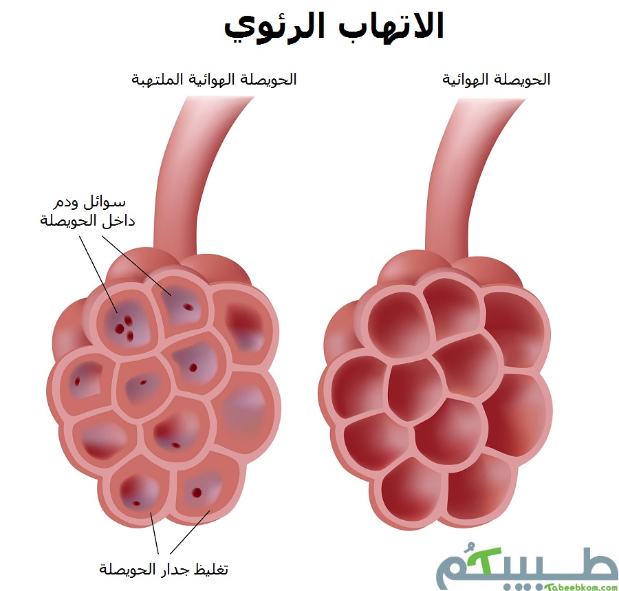 اعراض الالتهاب الرئوي: السعال، الحرارة المرتفعة، ضيق النفس وغيرها