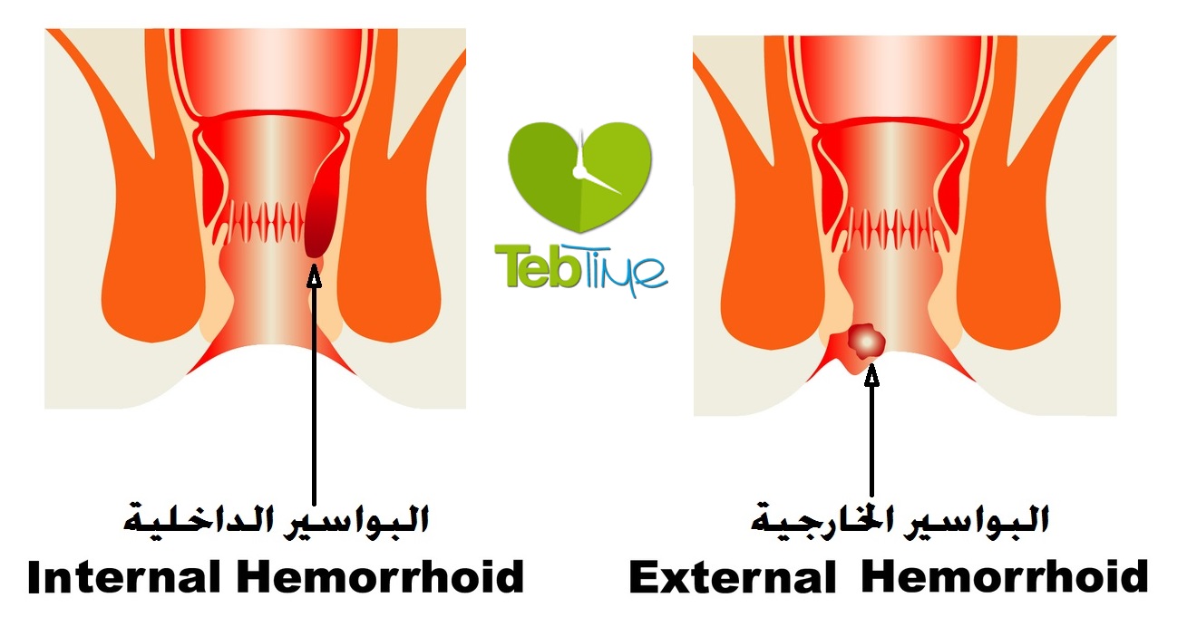 البواسير الداخلية والخارجية