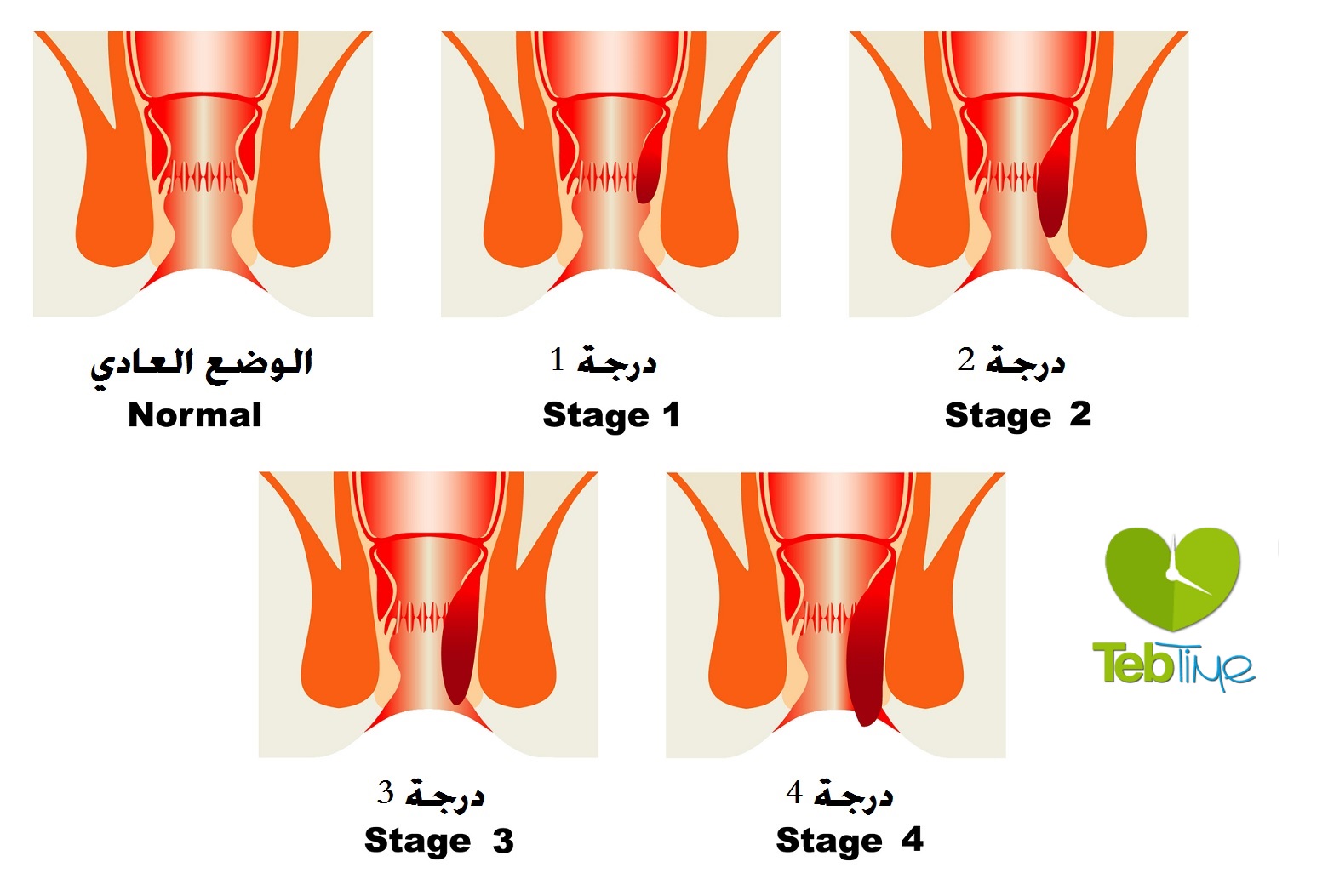 تصنيف درجات البواسير الداخلية