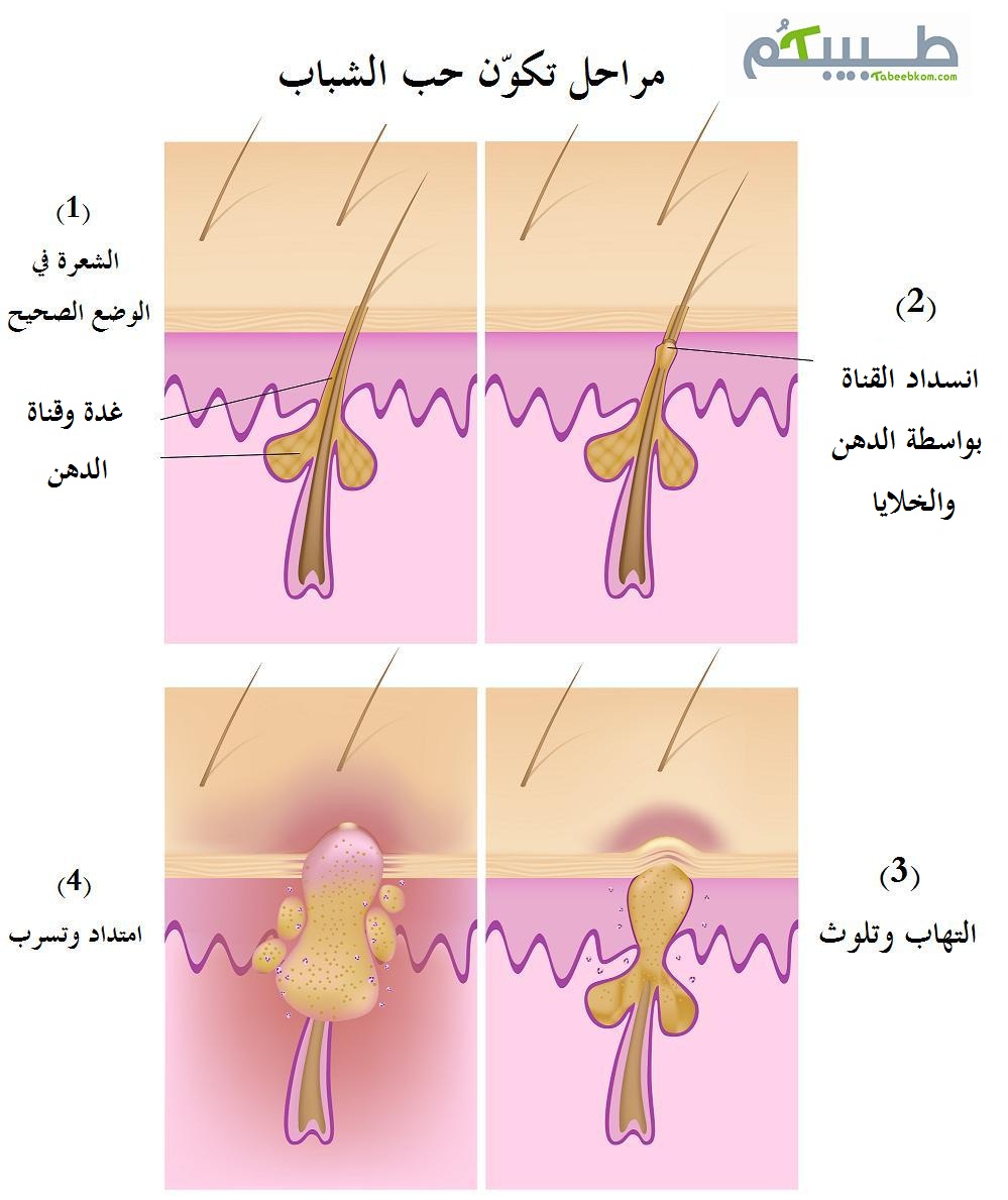 مراحل تكون حب الشباب