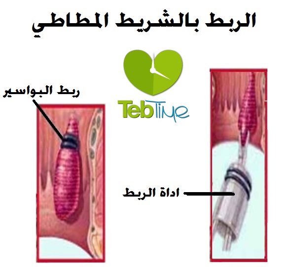 علاج البواسير:  الربط بالشريط المطاطي