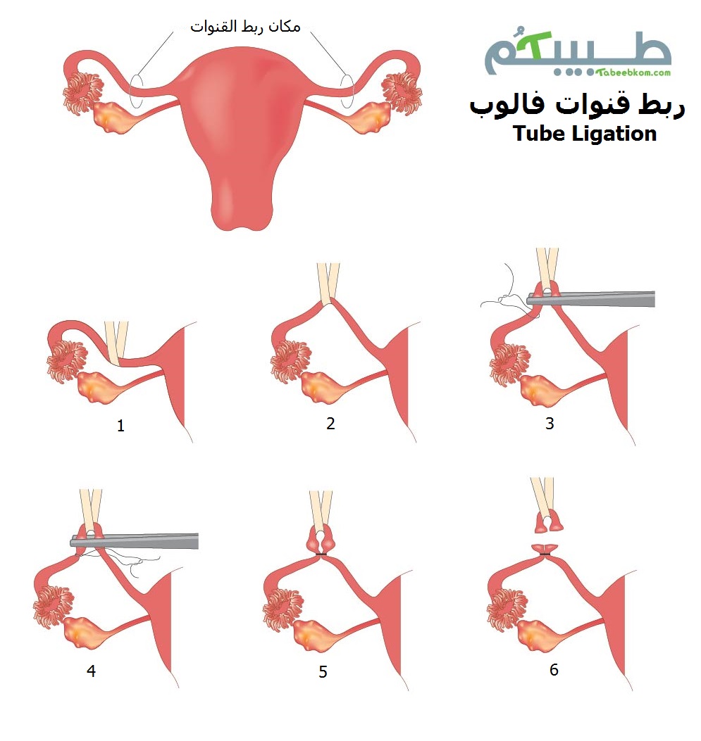 ربط قنوات فالوب - Tube Ligation