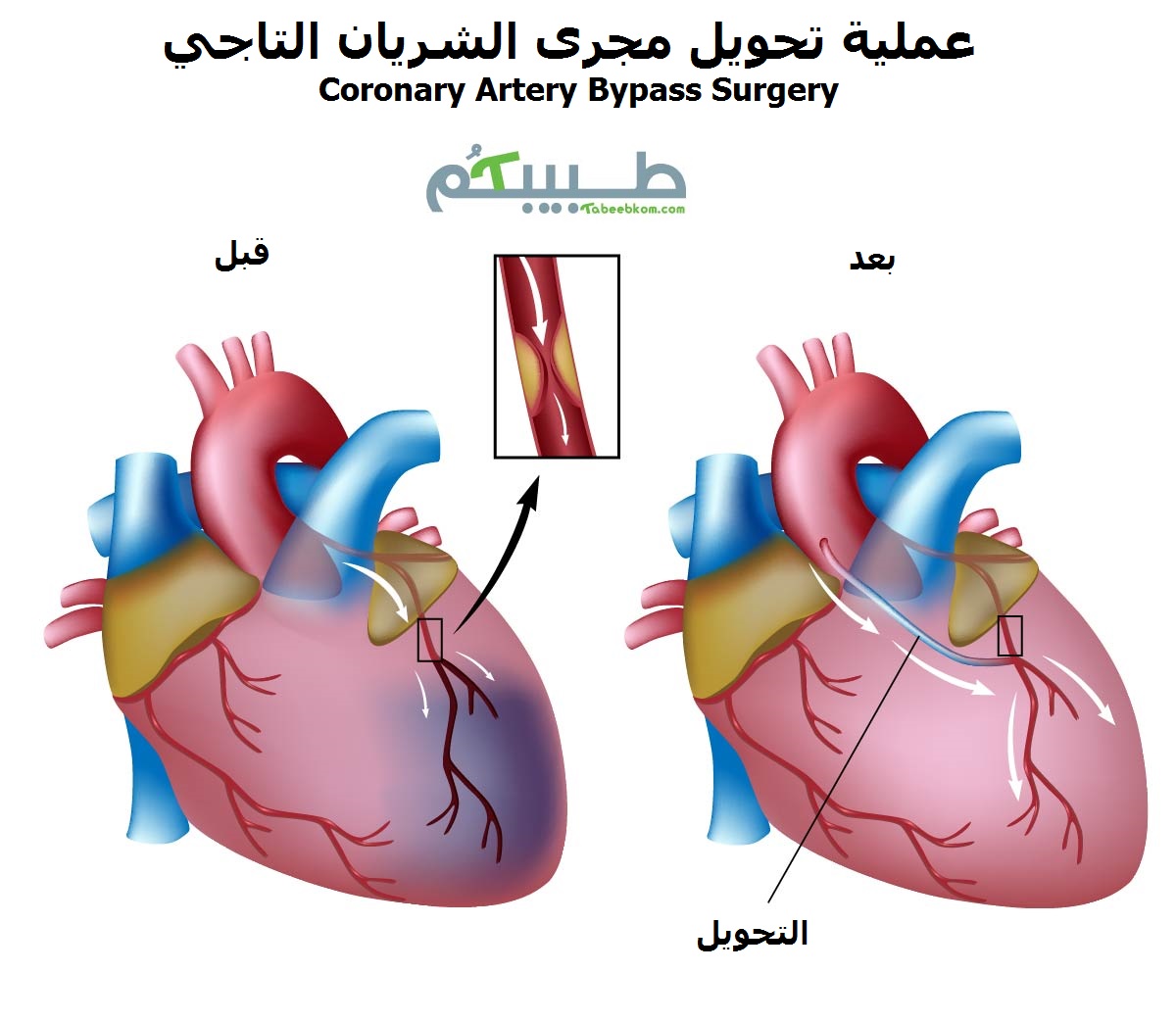 عملبة تحويل مجرى الشريان التاجي