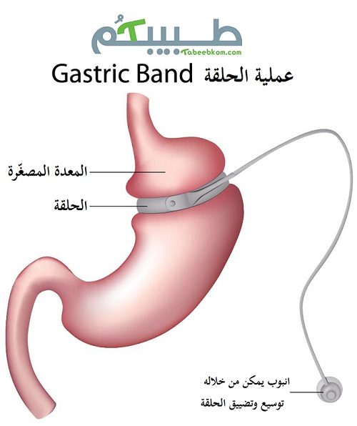 عملية ربط المعدة: الحلقة مصنوعة من السليكون، يتم ادخالها الى تجويف البطن وربط المعدة فيها بدون جراحة، ونستطيع التحكم فيها عن طريق انبوب يمكن من خلاله توسيعها وتضييقها
