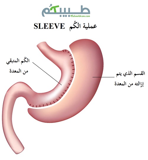 عملية قص المعدة: وهي عملية "الكُم" يتم خلالها قص المعدة وازالة نحو 80% - 70% من المعدة 