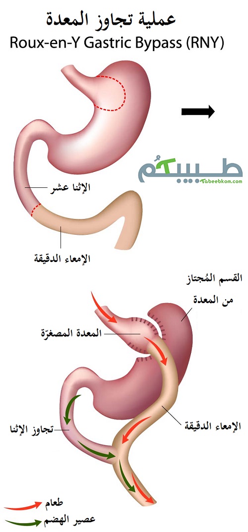 عملية تحويل المعدة او تجاوز المعدة هي الأكثر انتشارا في العالم اليوم وهي الأكثر تعقيدات ومضاعفات