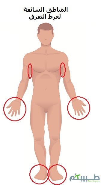 كف اليد، كف الرجل و تحت الابطين هي المناطق الشائعة لفرط التعرق