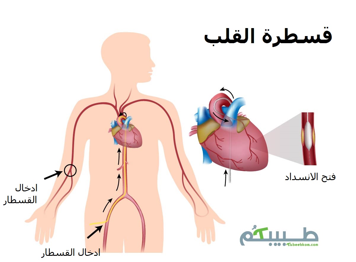 قسطرة القلب