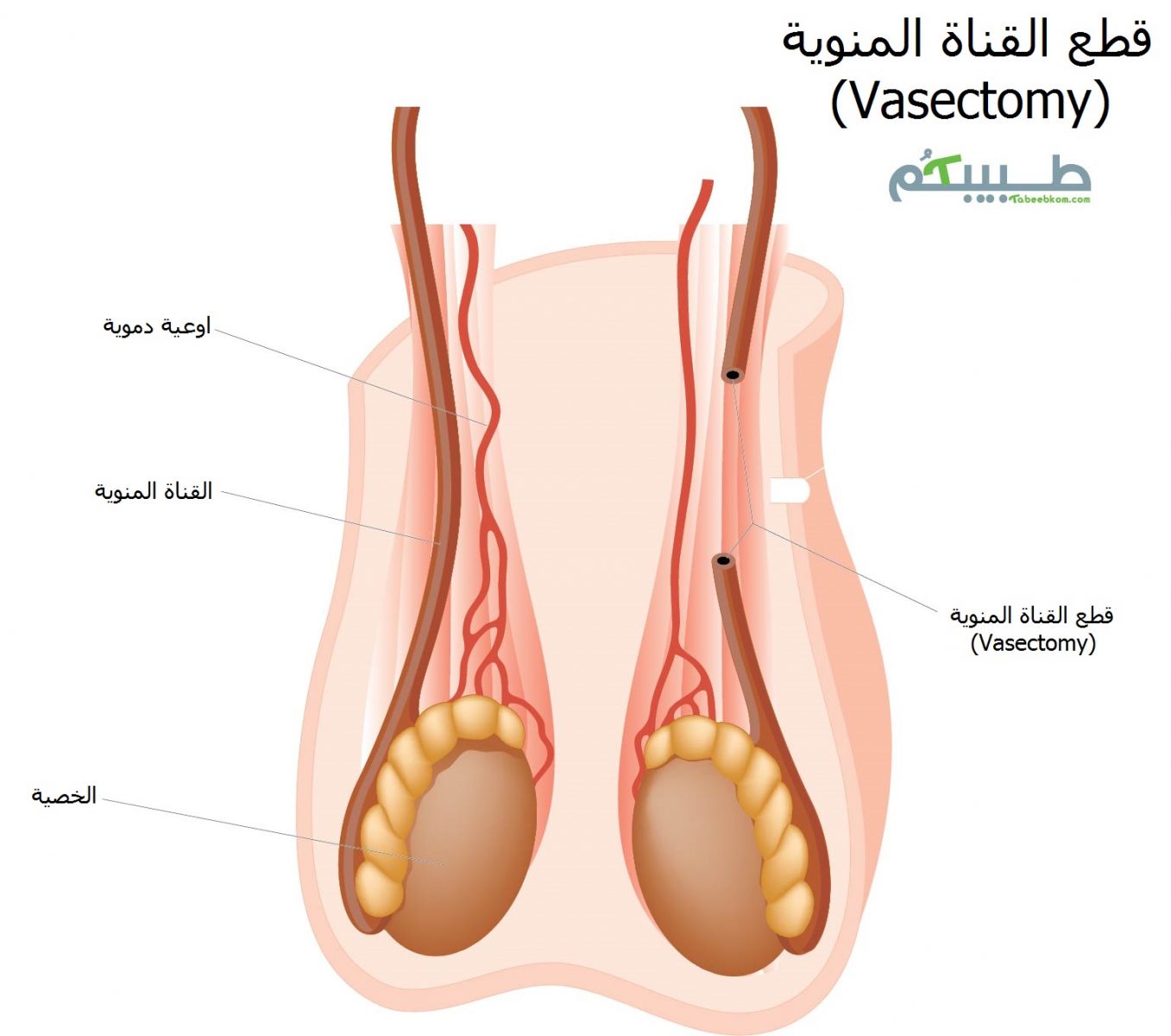 قطع القناة المنوية (Vasectomy)