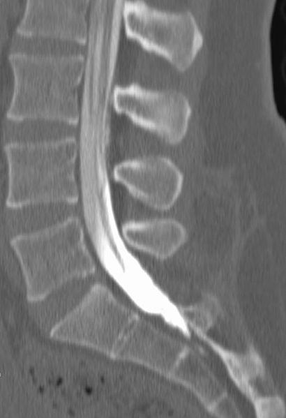 تصوير النّخاع (Myelography) لتشخيص حالة عرق النسا