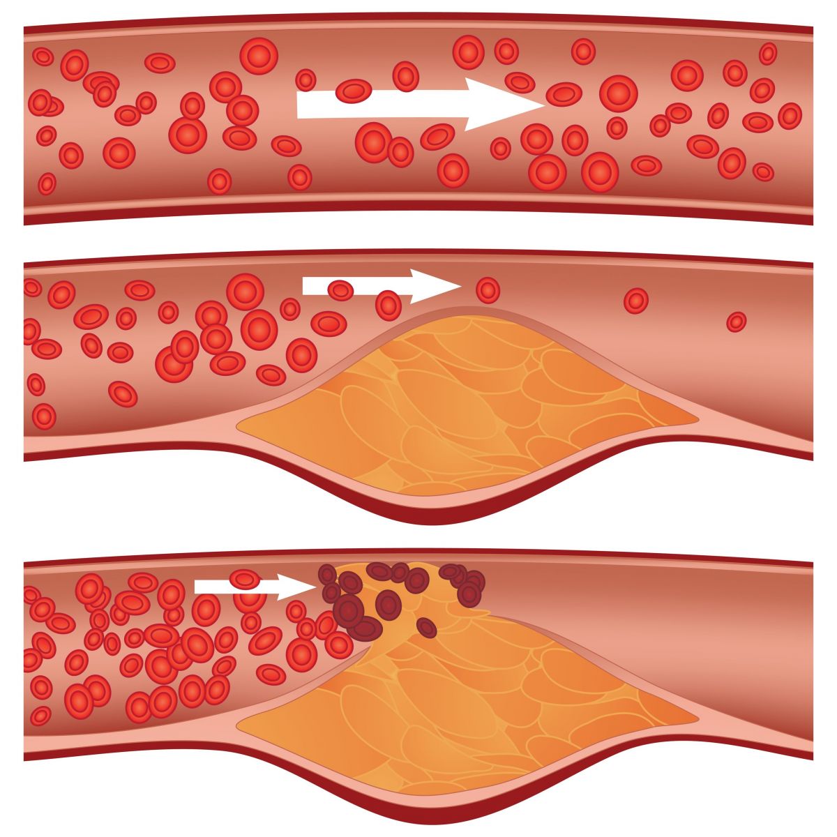 الكوليسترول سيف ذو حدين: المستويات المرتفعة من الكوليسترول الضار تسبب الى انسداد الاوعية الدموية