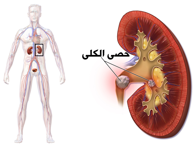 تكون حصى الكلى بحجمين