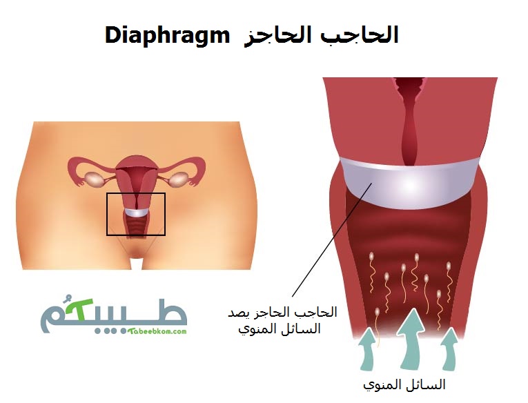 الحاجب الحاجز يصد السائل المنوي