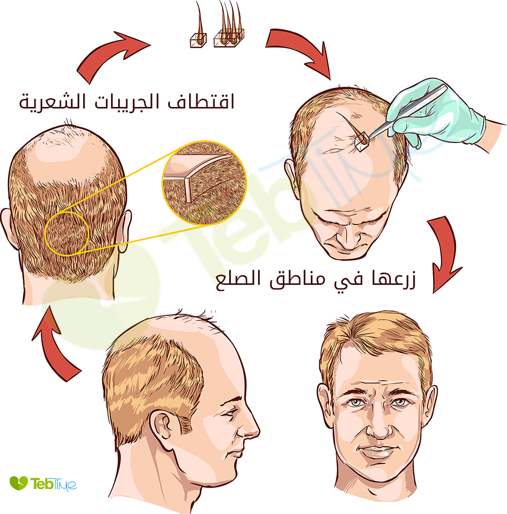 زراعة الشعر لعلاج الصلع الوراثي: اقتطاف جريبات الشعر من خلف الرأس وزراعتها في اماكن الصلع