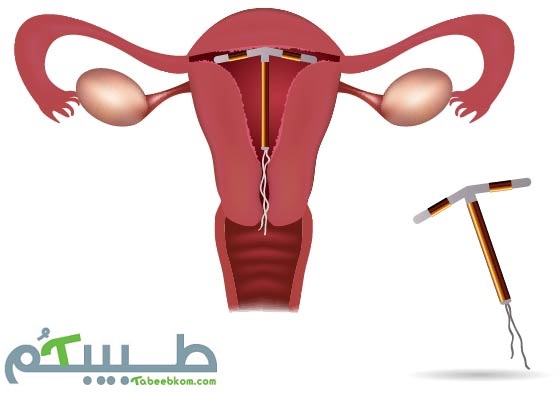 اللولب الرحمي - Intrauterine Device 