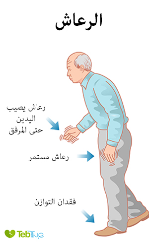 اعراض الرعاش