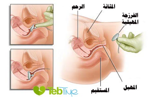 الفَرزَجَة المهبلية Vaginal pessary: احدى الطرق لعلاج هبوط الرحم