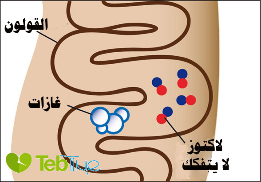 آلية حساسية اللاكتوز- او عدم تحمل اللاكتوز lactose intolerance