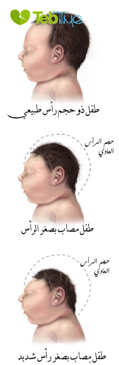أعراض وعلامات صغر الرأس: طفل ذو حجم رأس طبيعي، مقارنة بطفل مصاب بصغر الرأس