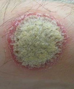 Psoriasis