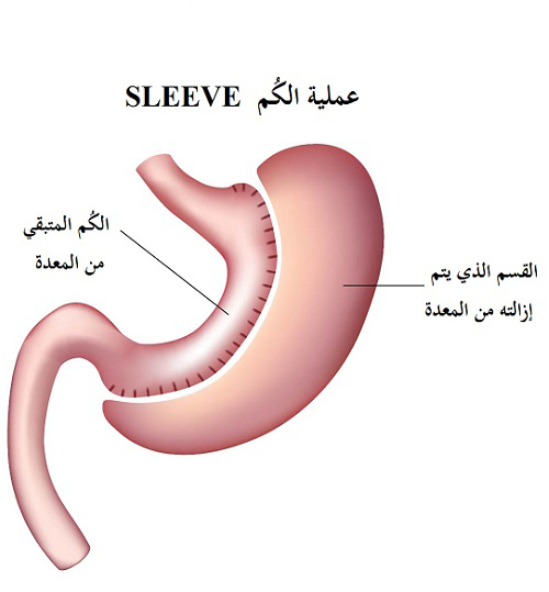 عملية تكميم المعدة Sleeve gastrectomy