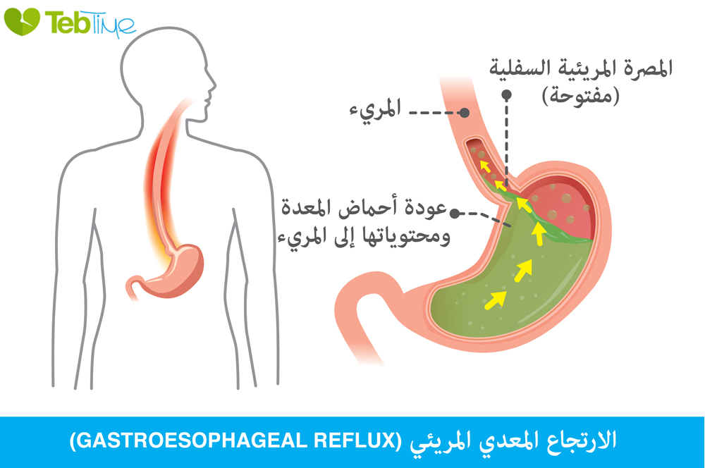 الارتجاع المعدي المريئي احد أهم العوامل للاصابة بالحرقة