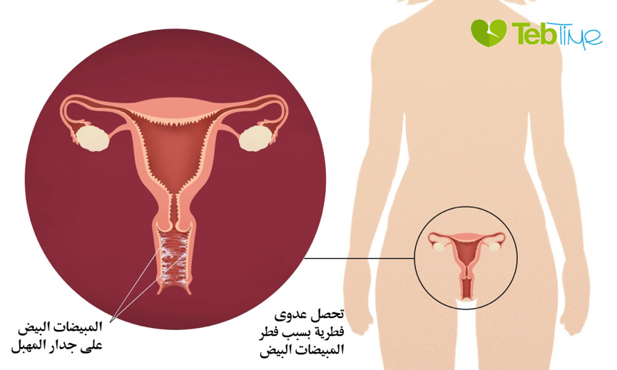 داء المبيضات Candidiasis من اكثر الاسباب للاصابة بعدوى المهبل بالفطريات