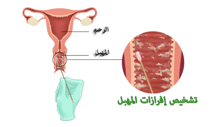 تشخيص الافرازات المهبلية: أخذ عينة أثناء الفحص الجسدي لتحديد نوع المكروبات