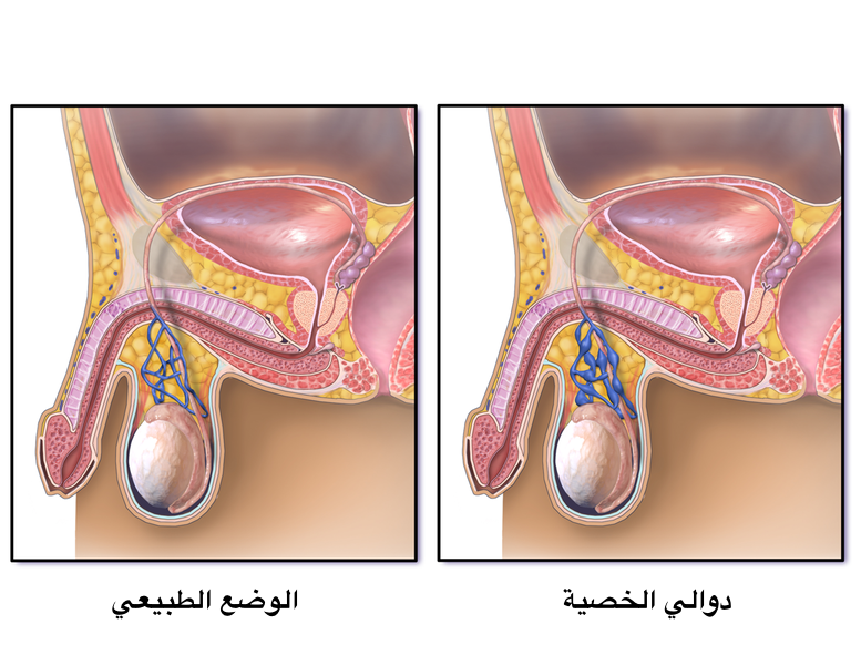 دوالي الخصية، مقارنة بالوضع الطبيعي