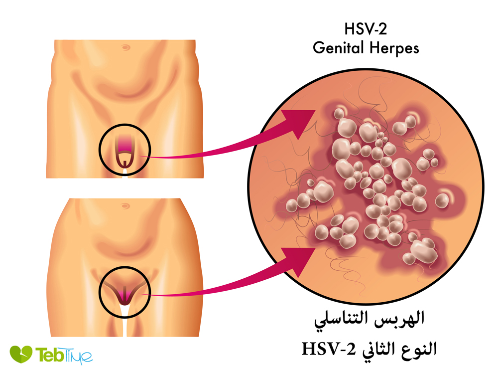 الهربس التناسلي- النوع الثاني HSV-2