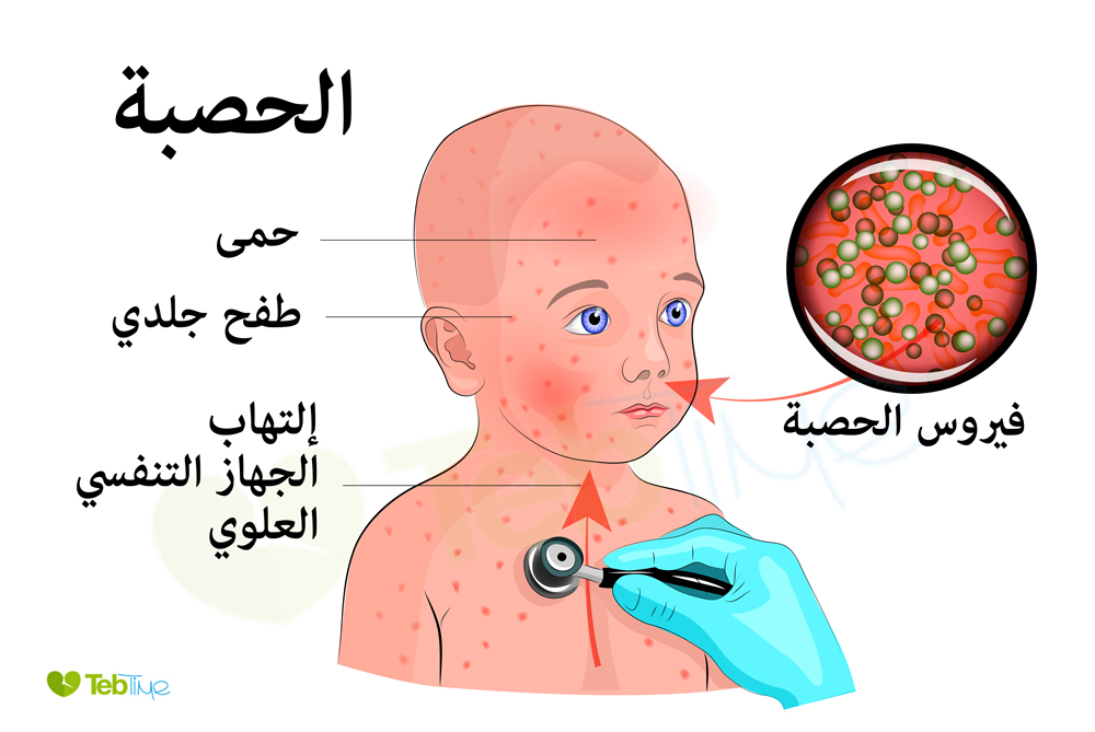 أعراض وعلامات الحصبة حمى وسيلان أنفي والتهاب بلعوم 