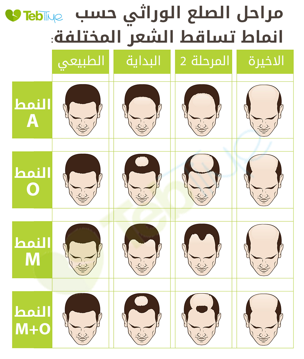 مراحل الصلع من البداية الى النهاية بمختلف انماط تساقط الشعر