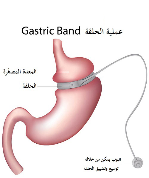 عمليّة ربط المعدة (laparoscopic adjustable gastric banding)