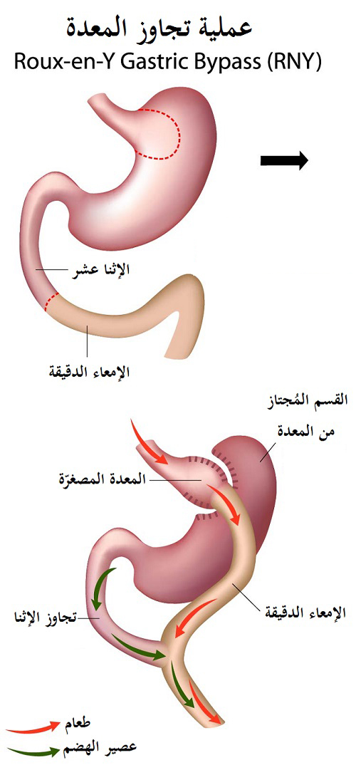 عمليّة المجازة المعديّة (gastric bypass surgery)