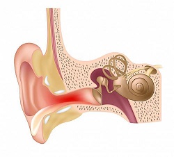 التهاب الأذن الظاهرة 