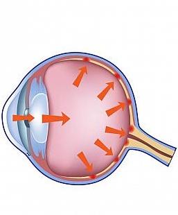 الزرق (Glaucoma)