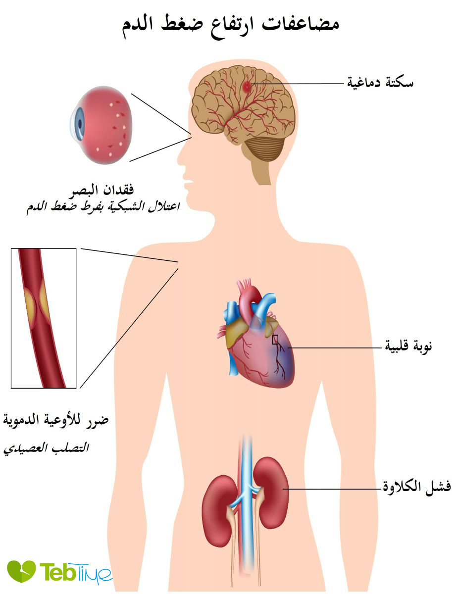 مضاعفات ارتفاع ضغط الدم