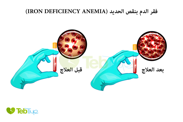 علاج فقر الدم بنقص الحديد (Iron Deficiency Anemia)