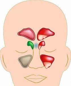 التهاب الجيوب الأنفية