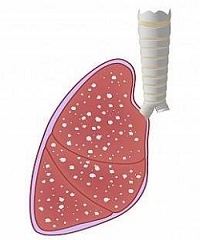 داء السل (Tuberculosis)