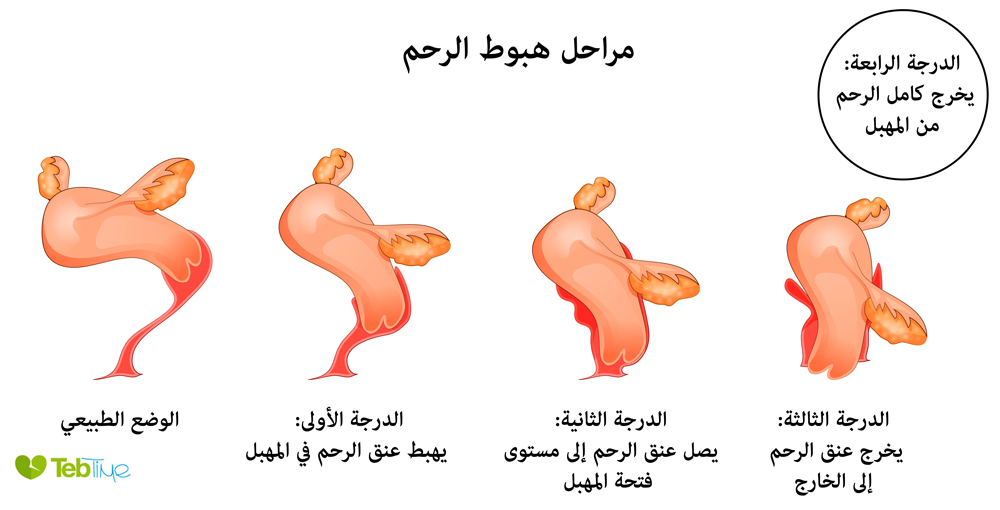 مراحل هبوط الرحم بالصور