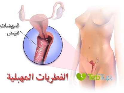 عدوى الفطريات المهبلية Vaginal Yeast Infection